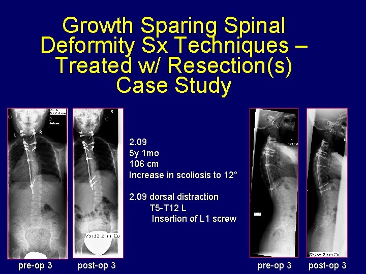 Growth Sparing Spinal Deformity Sx Techniques – Treated w/ Resection(s) Case Study 2. 09