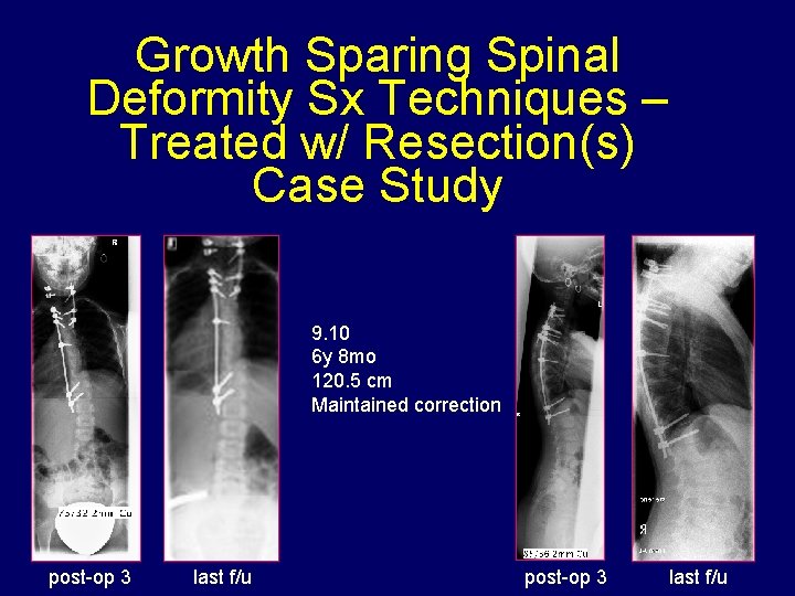 Growth Sparing Spinal Deformity Sx Techniques – Treated w/ Resection(s) Case Study 9. 10