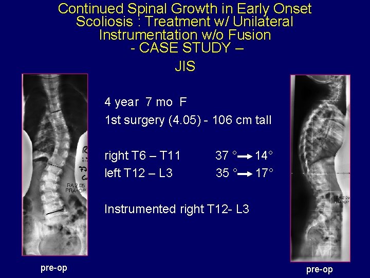 Continued Spinal Growth in Early Onset Scoliosis : Treatment w/ Unilateral Instrumentation w/o Fusion