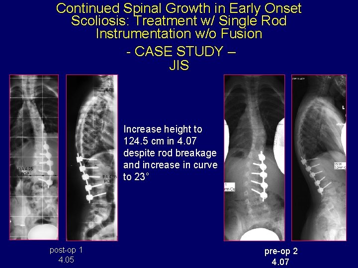 Continued Spinal Growth in Early Onset Scoliosis: Treatment w/ Single Rod Instrumentation w/o Fusion