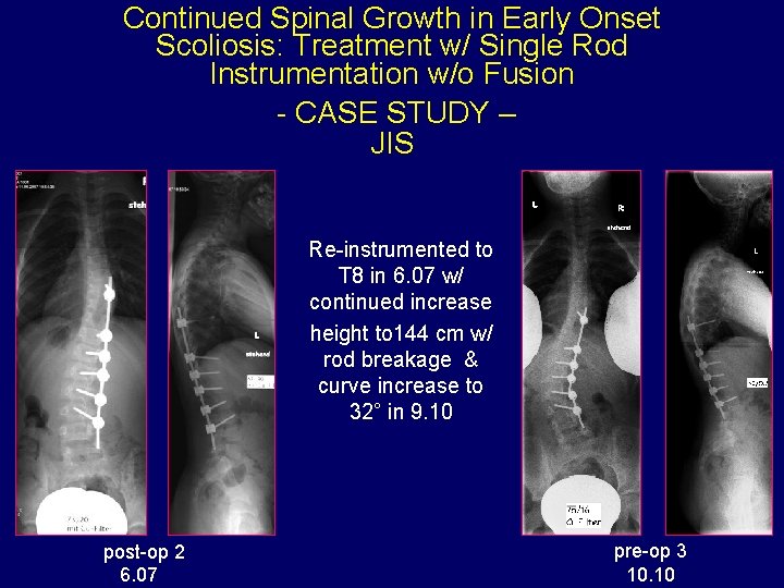 Continued Spinal Growth in Early Onset Scoliosis: Treatment w/ Single Rod Instrumentation w/o Fusion