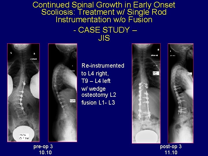 Continued Spinal Growth in Early Onset Scoliosis: Treatment w/ Single Rod Instrumentation w/o Fusion