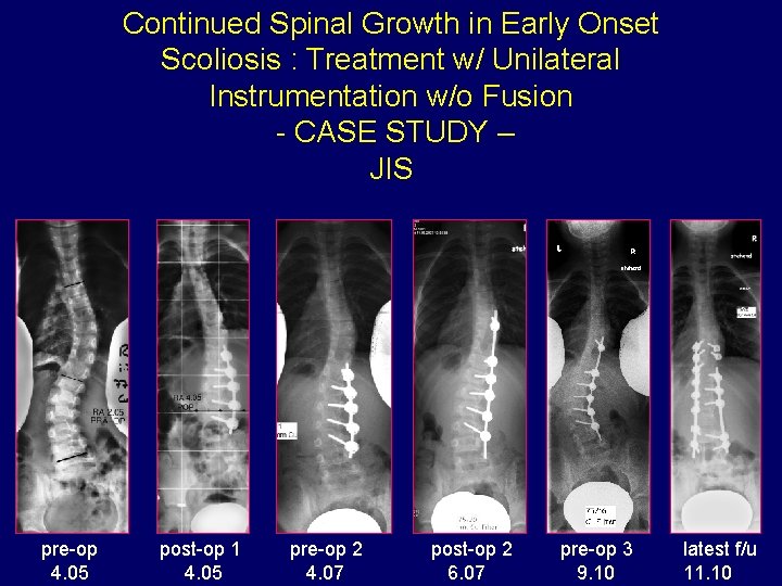 Continued Spinal Growth in Early Onset Scoliosis : Treatment w/ Unilateral Instrumentation w/o Fusion