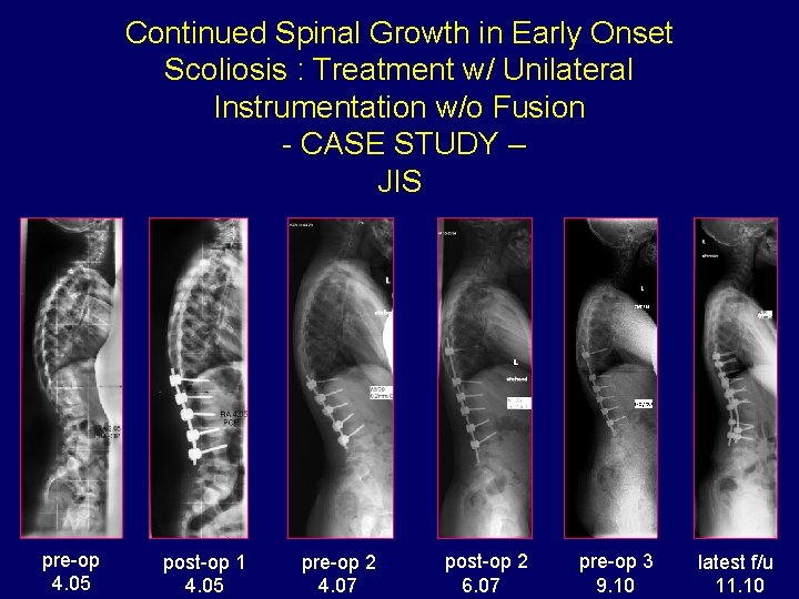 Continued Spinal Growth in Early Onset Scoliosis : Treatment w/ Unilateral Instrumentation w/o Fusion