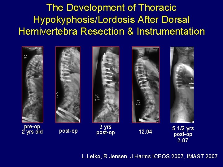 The Development of Thoracic Hypokyphosis/Lordosis After Dorsal Hemivertebra Resection & Instrumentation pre-op 2 yrs
