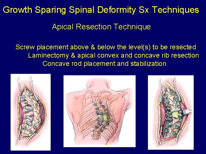 Growth Sparing Spinal Deformity Sx Techniques Apical Resection Technique Screw placement above & below