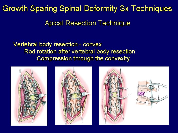 Growth Sparing Spinal Deformity Sx Techniques Apical Resection Technique Vertebral body resection - convex
