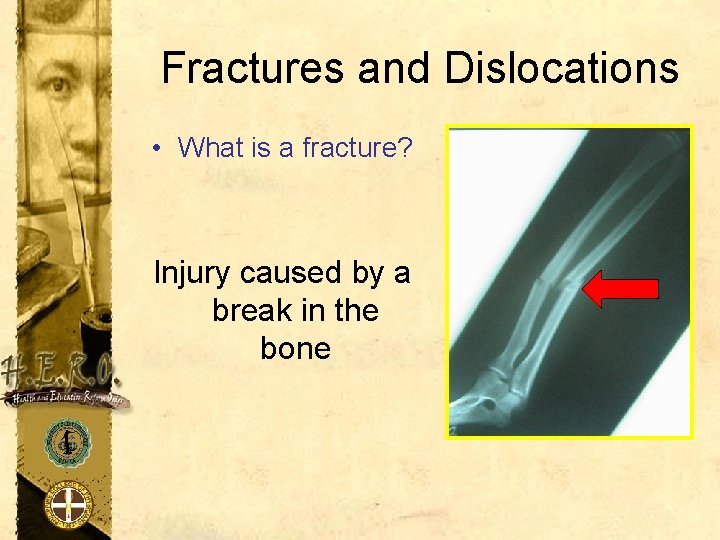 Fractures and Dislocations • What is a fracture? Injury caused by a break in