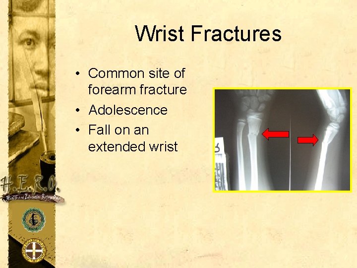 Wrist Fractures • Common site of forearm fracture • Adolescence • Fall on an