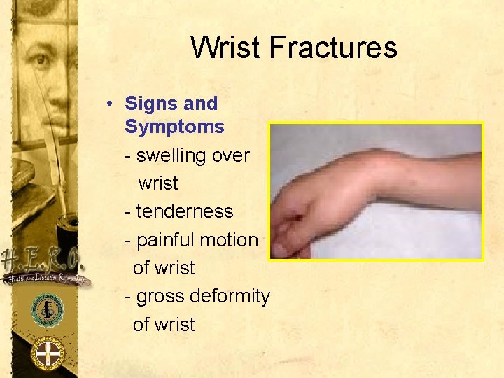 Wrist Fractures • Signs and Symptoms - swelling over wrist - tenderness - painful