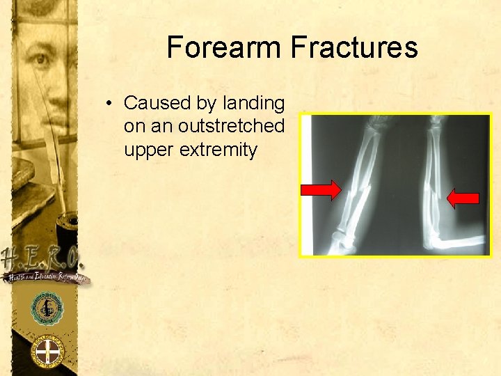 Forearm Fractures • Caused by landing on an outstretched upper extremity 