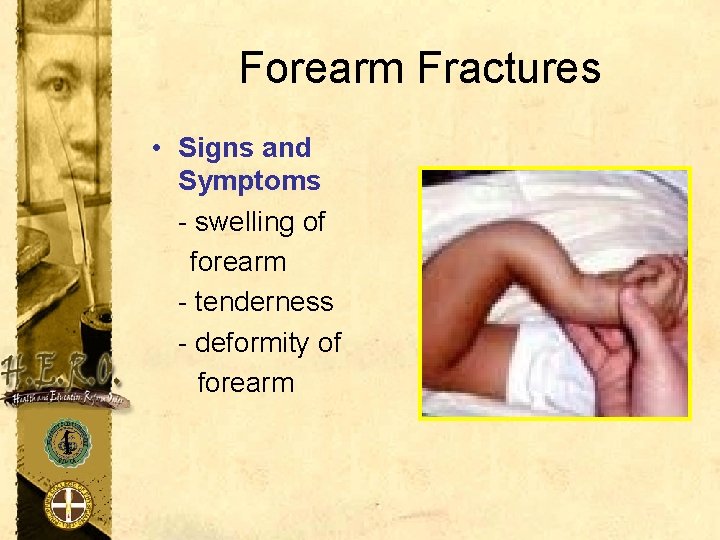 Forearm Fractures • Signs and Symptoms - swelling of forearm - tenderness - deformity