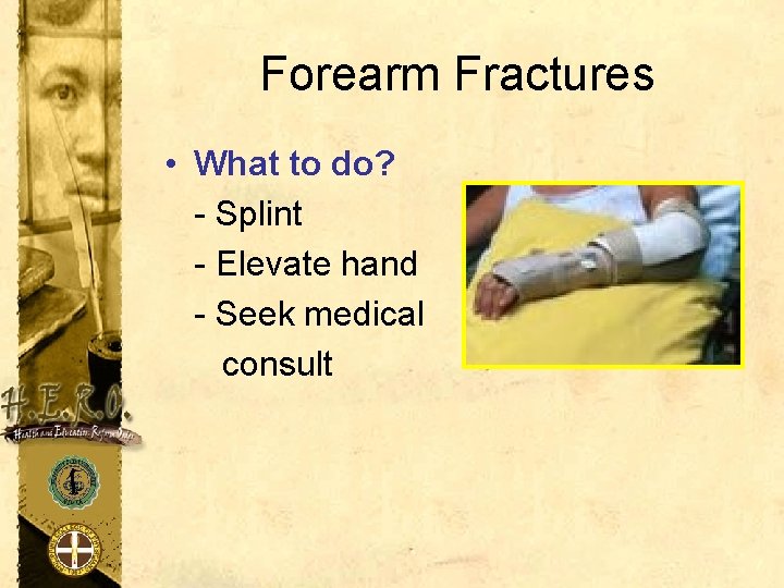 Forearm Fractures • What to do? - Splint - Elevate hand - Seek medical