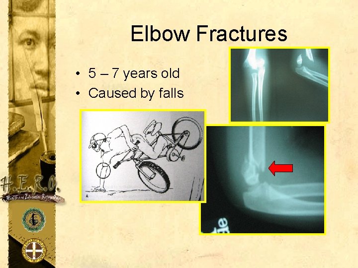 Elbow Fractures • 5 – 7 years old • Caused by falls 