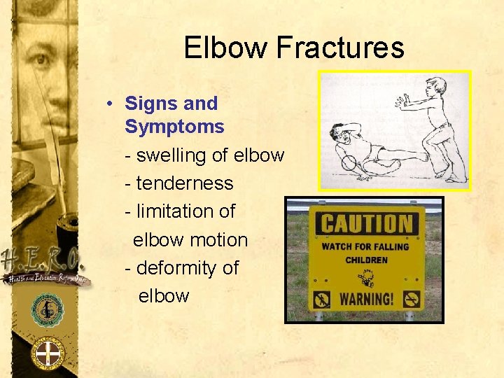 Elbow Fractures • Signs and Symptoms - swelling of elbow - tenderness - limitation