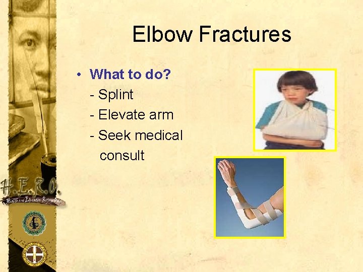 Elbow Fractures • What to do? - Splint - Elevate arm - Seek medical