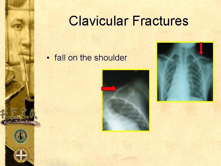 Clavicular Fractures • fall on the shoulder 