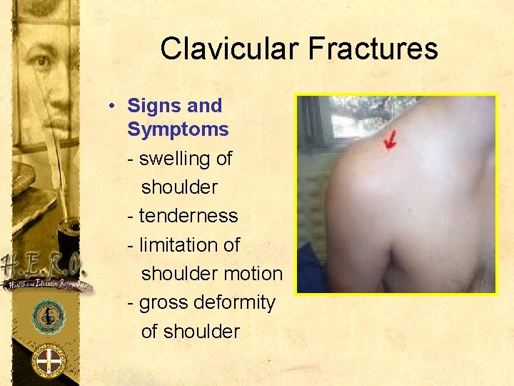 Clavicular Fractures • Signs and Symptoms - swelling of shoulder - tenderness - limitation