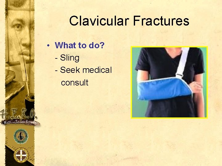 Clavicular Fractures • What to do? - Sling - Seek medical consult 