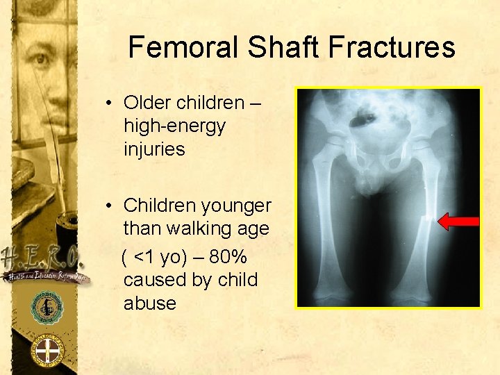 Femoral Shaft Fractures • Older children – high-energy injuries • Children younger than walking