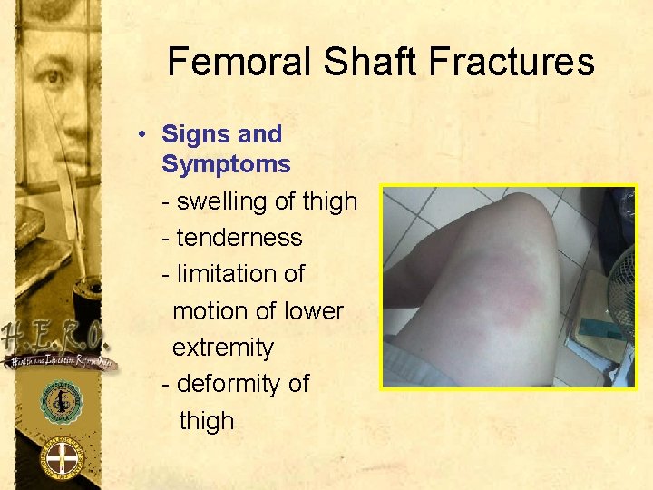 Femoral Shaft Fractures • Signs and Symptoms - swelling of thigh - tenderness -