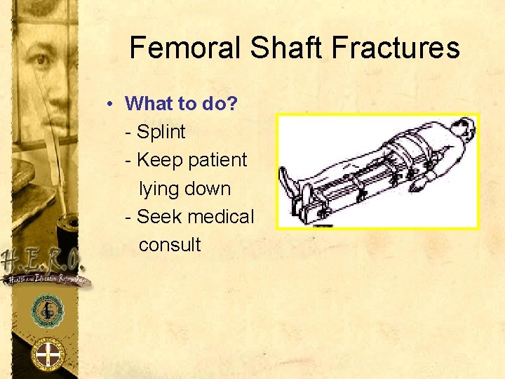 Femoral Shaft Fractures • What to do? - Splint - Keep patient lying down