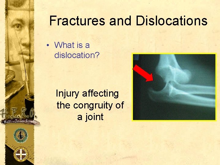 Fractures and Dislocations • What is a dislocation? Injury affecting the congruity of a