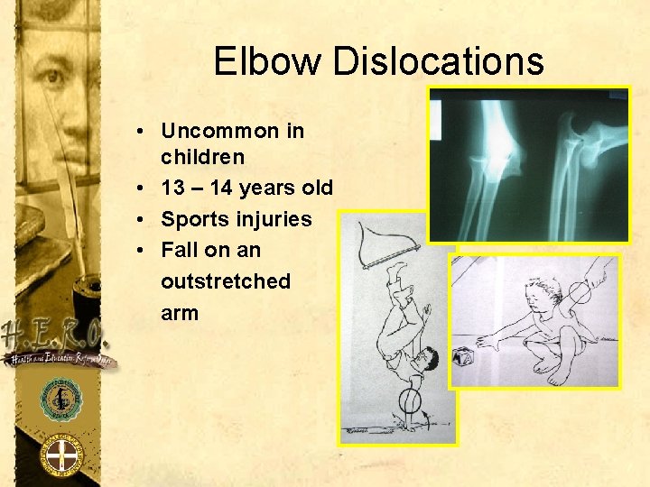 Elbow Dislocations • Uncommon in children • 13 – 14 years old • Sports