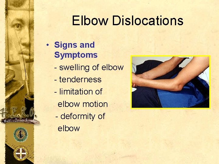 Elbow Dislocations • Signs and Symptoms - swelling of elbow - tenderness - limitation