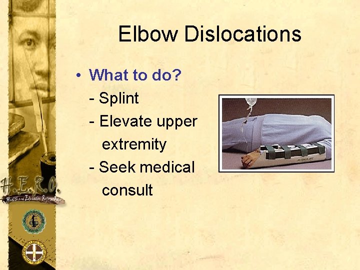 Elbow Dislocations • What to do? - Splint - Elevate upper extremity - Seek