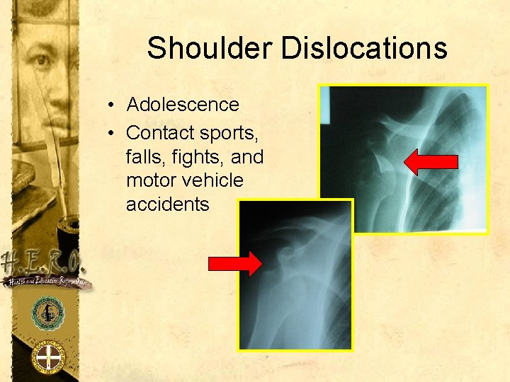 Shoulder Dislocations • Adolescence • Contact sports, falls, fights, and motor vehicle accidents 