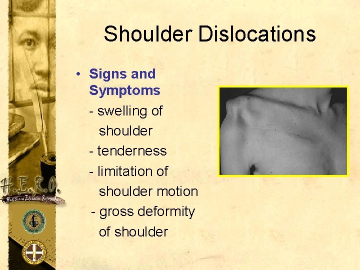 Shoulder Dislocations • Signs and Symptoms - swelling of shoulder - tenderness - limitation