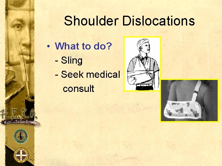 Shoulder Dislocations • What to do? - Sling - Seek medical consult 