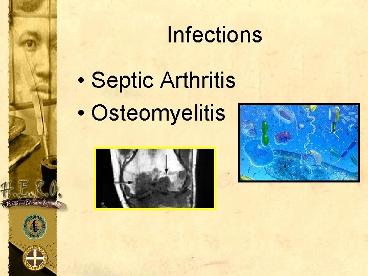 Infections • Septic Arthritis • Osteomyelitis 