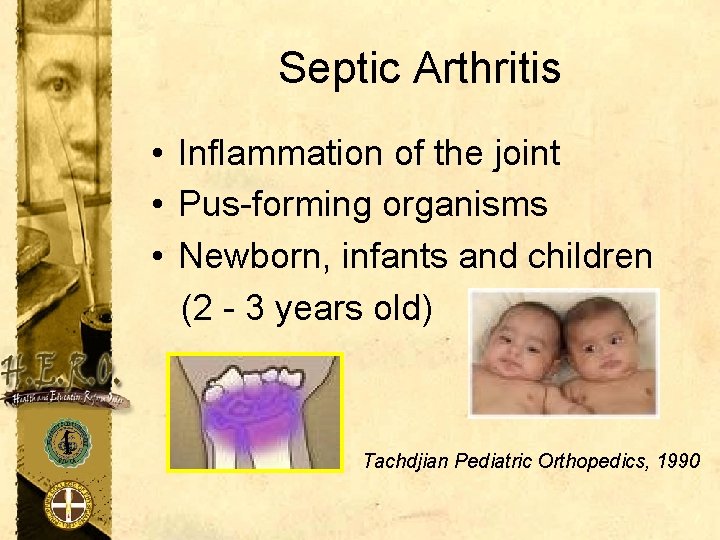 Septic Arthritis • Inflammation of the joint • Pus-forming organisms • Newborn, infants and