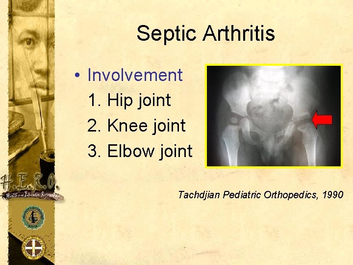 Septic Arthritis • Involvement 1. Hip joint 2. Knee joint 3. Elbow joint Tachdjian