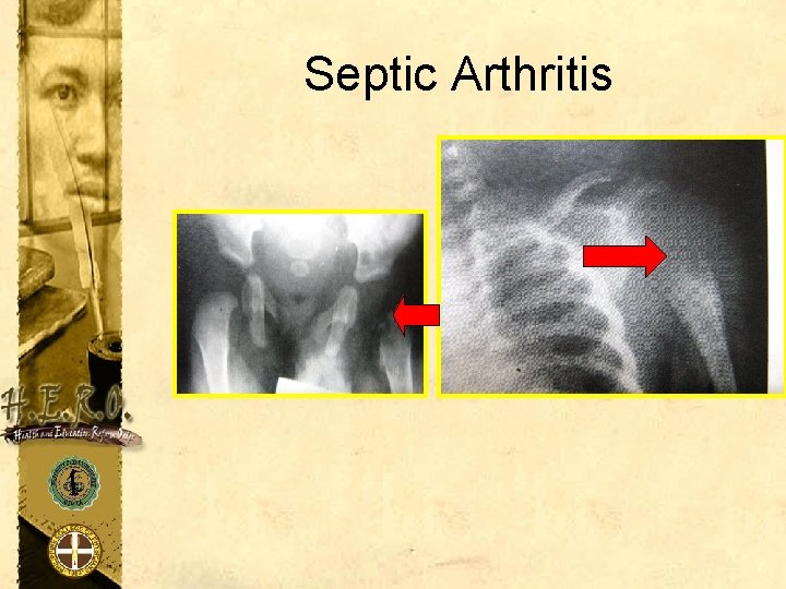 Septic Arthritis 