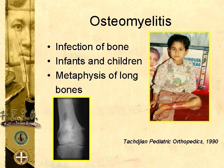Osteomyelitis • Infection of bone • Infants and children • Metaphysis of long bones
