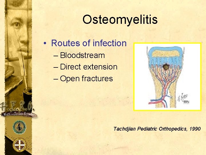 Osteomyelitis • Routes of infection – Bloodstream – Direct extension – Open fractures Tachdjian