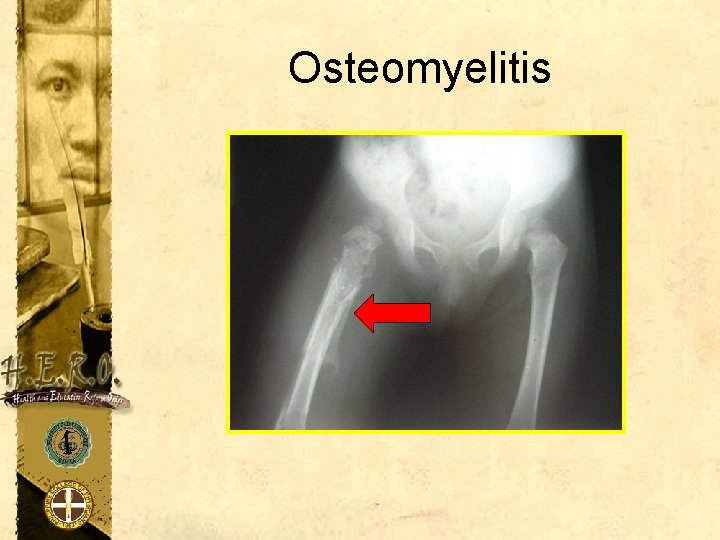Osteomyelitis 