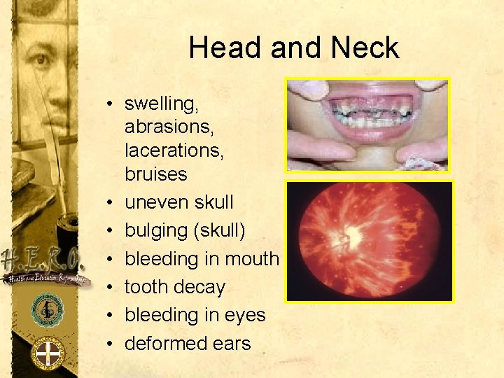 Head and Neck • swelling, abrasions, lacerations, bruises • uneven skull • bulging (skull)