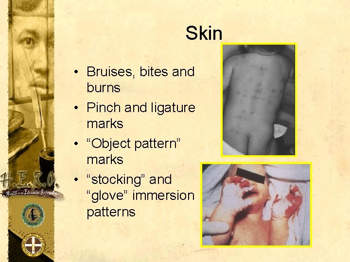 Skin • Bruises, bites and burns • Pinch and ligature marks • “Object pattern”