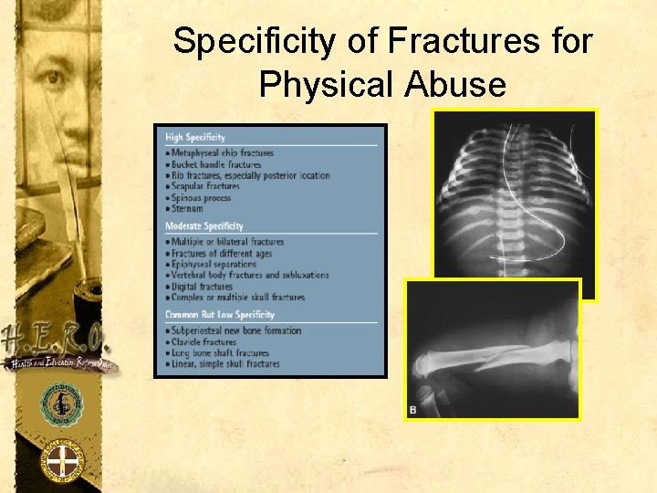 Specificity of Fractures for Physical Abuse 