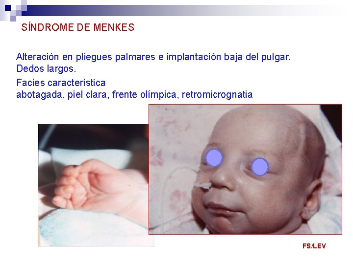 SÍNDROME DE MENKES Alteración en pliegues palmares e implantación baja del pulgar. Dedos largos.