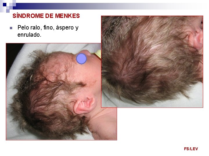 SÍNDROME DE MENKES n Pelo ralo, fino, áspero y enrulado. FS/LEV 