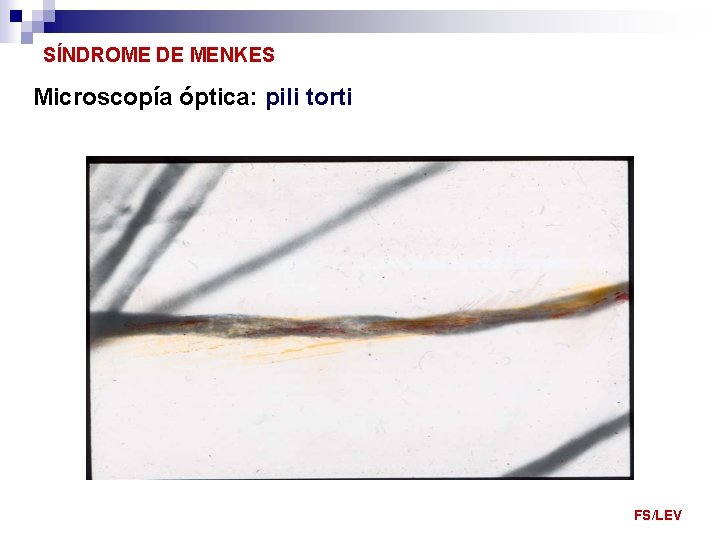 SÍNDROME DE MENKES Microscopía óptica: pili torti FS/LEV 