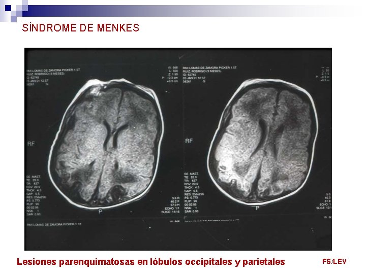 SÍNDROME DE MENKES Lesiones parenquimatosas en lóbulos occipitales y parietales FS/LEV 