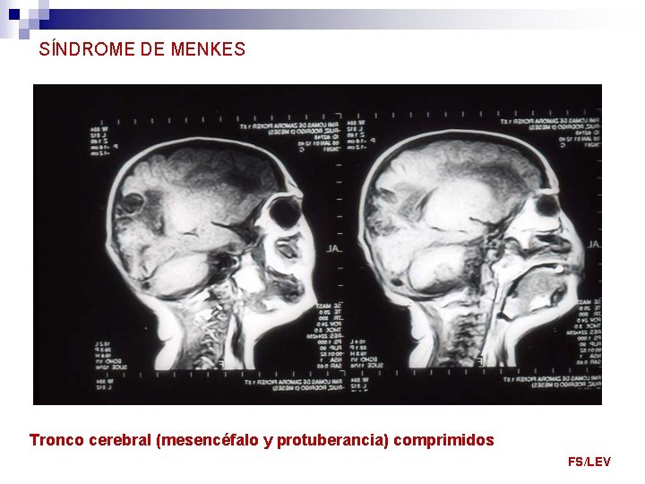 SÍNDROME DE MENKES Tronco cerebral (mesencéfalo y protuberancia) comprimidos FS/LEV 