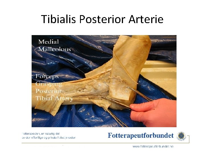 Tibialis Posterior Arterie 