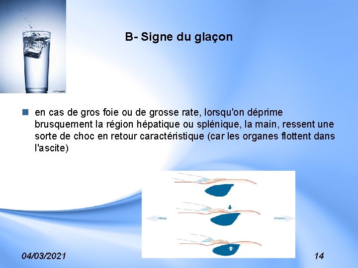 B- Signe du glaçon n en cas de gros foie ou de grosse rate,